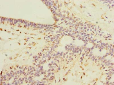 ROPN1L Antibody - Immunohistochemistry of paraffin-embedded human breast cancer using antibody at dilution of 1:100.