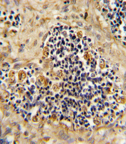 ROR2 Antibody - Formalin-fixed and paraffin-embedded human kidney carcinoma reacted with ROR2 Antibody , which was peroxidase-conjugated to the secondary antibody, followed by DAB staining. This data demonstrates the use of this antibody for immunohistochemistry; clinical relevance has not been evaluated.