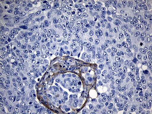 ROR2 Antibody - Immunohistochemical staining of paraffin-embedded Adenocarcinoma of Human ovary tissue using anti-ROR2 mouse monoclonal antibody. (Heat-induced epitope retrieval by 1mM EDTA in 10mM Tris buffer. (pH8.5) at 120°C for 3 min. (1:500)