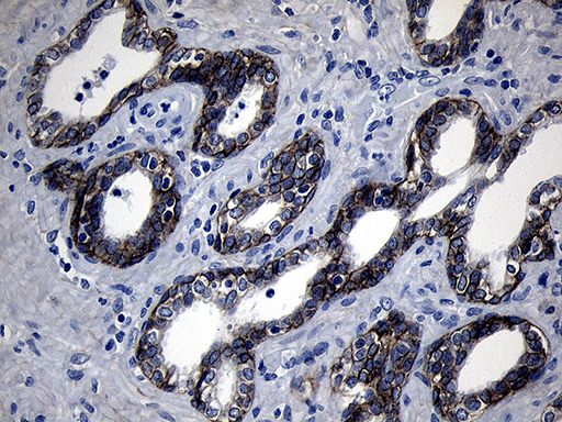 ROR2 Antibody - Immunohistochemical staining of paraffin-embedded Carcinoma of Human prostate tissue using anti-ROR2 mouse monoclonal antibody. (Heat-induced epitope retrieval by 1mM EDTA in 10mM Tris buffer. (pH8.5) at 120°C for 3 min. (1:500)