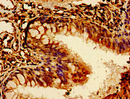 ROR2 Antibody - Immunohistochemistry image of paraffin-embedded human lung cancer at a dilution of 1:100