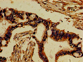 ROR2 Antibody - Immunohistochemistry image of paraffin-embedded human pancreatic cancer at a dilution of 1:100
