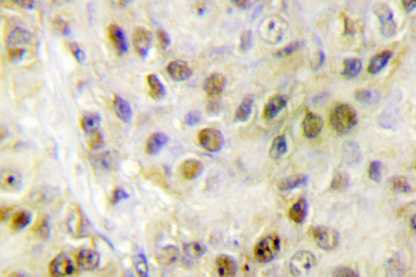 RORA / ROR Alpha Antibody - IHC of ROR (G41) pAb in paraffin-embedded human breast carcinoma tissue.