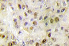 RORA / ROR Alpha Antibody - IHC of ROR (G41) pAb in paraffin-embedded human breast carcinoma tissue.