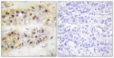 RORA / ROR Alpha Antibody - Peptide - + Immunohistochemistry analysis of paraffin-embedded human breast carcinoma tissue using RORA antibody.