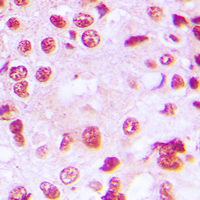 RORA / ROR Alpha Antibody - Immunohistochemical analysis of ROR alpha staining in human lung cancer formalin fixed paraffin embedded tissue section. The section was pre-treated using heat mediated antigen retrieval with sodium citrate buffer (pH 6.0). The section was then incubated with the antibody at room temperature and detected using an HRP conjugated compact polymer system. DAB was used as the chromogen. The section was then counterstained with hematoxylin and mounted with DPX.