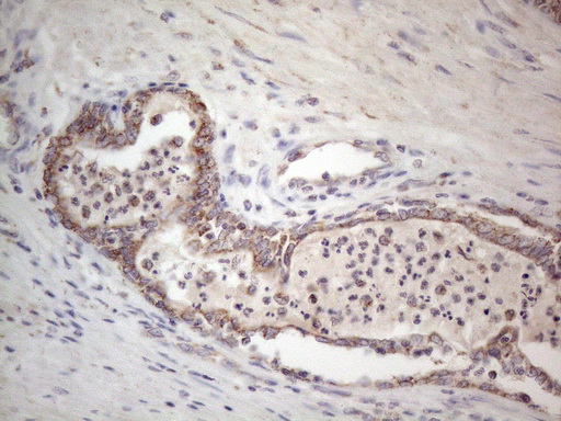 RORB / ROR Beta Antibody - Immunohistochemical staining of paraffin-embedded Carcinoma of Human prostate tissue using anti-RORB mouse monoclonal antibody. (Heat-induced epitope retrieval by 1mM EDTA in 10mM Tris buffer. (pH8.5) at 120°C for 3 min. (1:150)