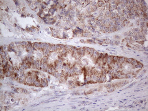 RORB / ROR Beta Antibody - Immunohistochemical staining of paraffin-embedded Adenocarcinoma of Human colon tissue using anti-RORB mouse monoclonal antibody. (Heat-induced epitope retrieval by 1mM EDTA in 10mM Tris buffer. (pH8.5) at 120°C for 3 min. (1:150)