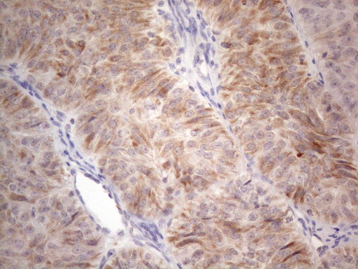 RORB / ROR Beta Antibody - Immunohistochemical staining of paraffin-embedded Adenocarcinoma of Human ovary tissue using anti-RORB mouse monoclonal antibody. (Heat-induced epitope retrieval by 1mM EDTA in 10mM Tris buffer. (pH8.5) at 120°C for 3 min. (1:150)