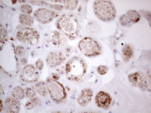 RORB / ROR Beta Antibody - Immunohistochemical staining of paraffin-embedded Carcinoma of Human thyroid tissue using anti-RORB mouse monoclonal antibody. (Heat-induced epitope retrieval by 1mM EDTA in 10mM Tris buffer. (pH8.5) at 120°C for 3 min. (1:150)