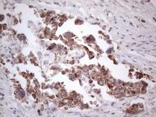 RORB / ROR Beta Antibody - Immunohistochemical staining of paraffin-embedded Adenocarcinoma of Human breast tissue using anti-RORB mouse monoclonal antibody. (Heat-induced epitope retrieval by 1mM EDTA in 10mM Tris buffer. (pH8.5) at 120°C for 3 min. (1:150)