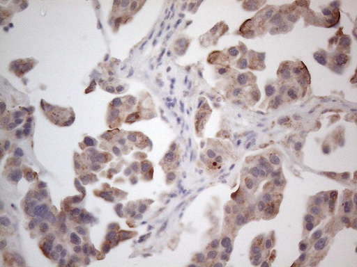 RORB / ROR Beta Antibody - Immunohistochemical staining of paraffin-embedded Carcinoma of Human bladder tissue using anti-RORB mouse monoclonal antibody. (Heat-induced epitope retrieval by 1mM EDTA in 10mM Tris buffer. (pH8.5) at 120°C for 3 min. (1:150)