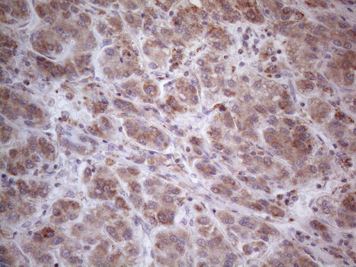 RORB / ROR Beta Antibody - Immunohistochemical staining of paraffin-embedded Carcinoma of Human liver tissue using anti-RORB mouse monoclonal antibody. (Heat-induced epitope retrieval by 1mM EDTA in 10mM Tris buffer. (pH8.5) at 120°C for 3 min. (1:150)