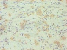 RORC / ROR Gamma Antibody - Immunohistochemistry of paraffin-embedded human breast cancer using antibody at 1:100 dilution.  This image was taken for the unconjugated form of this product. Other forms have not been tested.