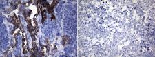 ROS1 / ROS Antibody - Immunohistochemical staining of paraffin-embedded HCC78. (left) and HeLa. (right) xenograft using(0.2ug/ml). (Heat-induced epitope retrieval by 1mM EDTA in 10mM Tris buffer. (pH8.0) at 120°C for 3 min).