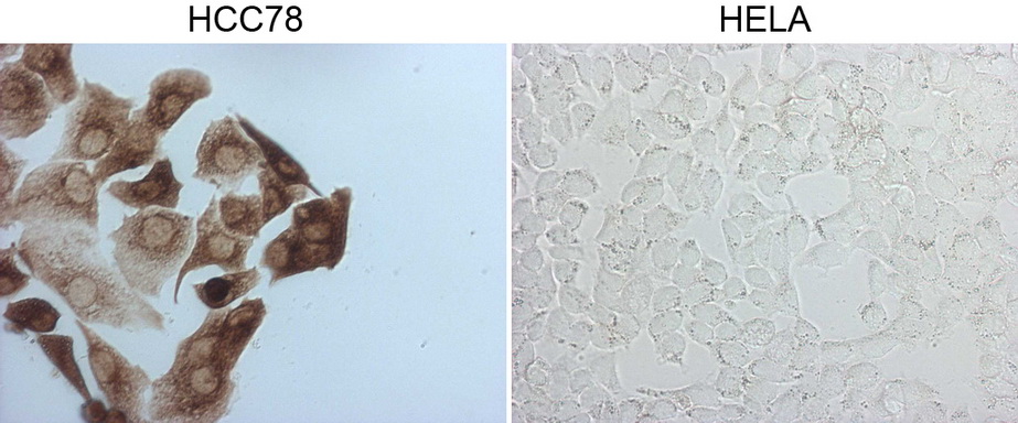 ROS1 / ROS Antibody - Immunocytochemistry staining of HCC78 cells using anti-ROS1 mouse monoclonal antibody. (Left). The right is HELA cells as negative control.