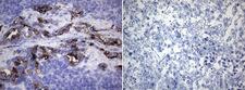 ROS1 / ROS Antibody - Immunohistochemical staining of paraffin-embedded HCC78. (left) and HeLa. (right) xenograft using ROS1. (OTI1A1) mAb. (Heat-induced epitope retrieval by 1mM EDTA in 10mM Tris buffer. (pH9.0) at 120°C for 3 min. (1:10000)