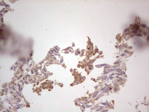 ROS1 / ROS Antibody - IHC of paraffin-embedded Carcinoma of ROS1 positive Human lung tissue using anti-ROS1 mouse monoclonal antibody. (heat-induced epitope retrieval by 1 mM EDTA in 10mM Tris, pH8.5, 120°C for 3min).