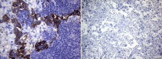 ROS1 / ROS Antibody - Immunohistochemical staining of paraffin-embedded HCC78. (left) and HeLa. (right) xenograft using(0.2ug/ml). (Heat-induced epitope retrieval by 1mM EDTA in 10mM Tris buffer. (pH8.0) at 120°C for 3 min)