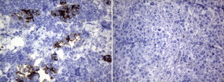 ROS1 / ROS Antibody - Immunohistochemical staining of paraffin-embedded HCC78. (left) and HeLa. (right) xenograft using(0.2ug/ml). (Heat-induced epitope retrieval by 1mM EDTA in 10mM Tris buffer. (pH8.0) at 120°C for 3 min)