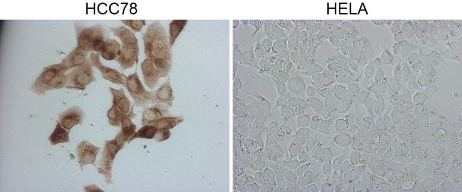 ROS1 / ROS Antibody - Immunocytochemistry staining of HCC78 cells using anti-ROS1 mouse monoclonal antibody. (Left). The right is HELA cells as negative control. (1:2000)