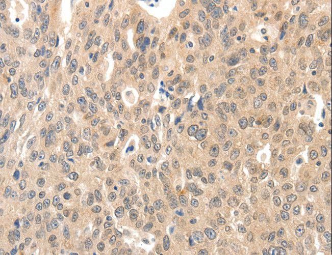 ROS1 / ROS Antibody - Immunohistochemistry of paraffin-embedded Human ovarian cancer using ROS1 Polyclonal Antibody at dilution of 1:40.
