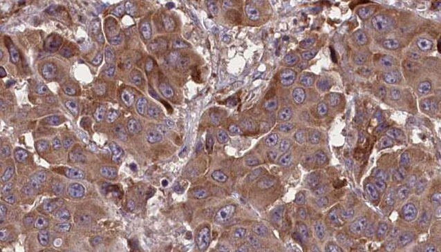 RP105 / CD180 Antibody - 1:100 staining human liver carcinoma tissues by IHC-P. The sample was formaldehyde fixed and a heat mediated antigen retrieval step in citrate buffer was performed. The sample was then blocked and incubated with the antibody for 1.5 hours at 22°C. An HRP conjugated goat anti-rabbit antibody was used as the secondary.