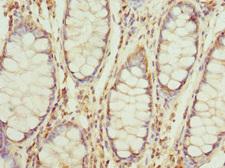 RP2 Antibody - Immunohistochemistry of paraffin-embedded human colon cancer at dilution 1:100