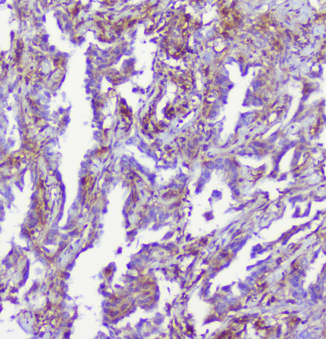 RP2 Antibody - IHC analysis of RP2 using anti-RP2 antibody. RP2 was detected in paraffin-embedded section of human lung cancer tissue. Heat mediated antigen retrieval was performed in citrate buffer (pH6, epitope retrieval solution) for 20 mins. The tissue section was blocked with 10% goat serum. The tissue section was then incubated with 1µg/ml rabbit anti-RP2 Antibody overnight at 4°C. Biotinylated goat anti-rabbit IgG was used as secondary antibody and incubated for 30 minutes at 37°C. The tissue section was developed using Strepavidin-Biotin-Complex (SABC) with DAB as the chromogen.