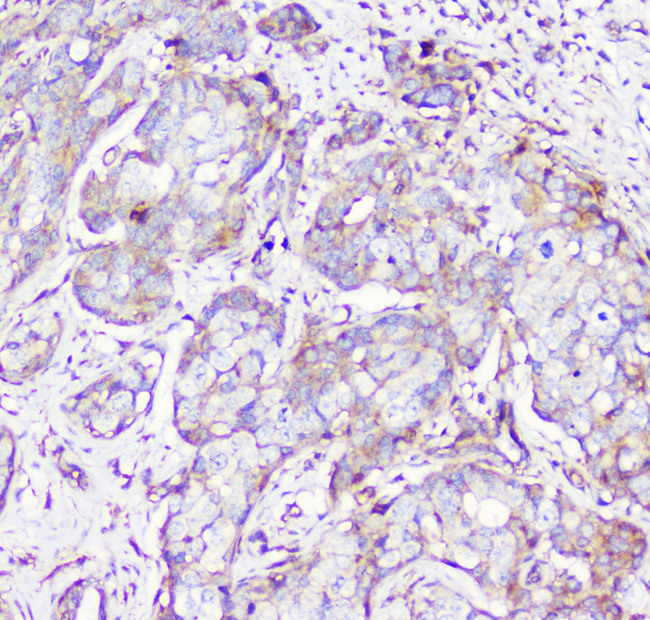 RP2 Antibody - IHC analysis of RP2 using anti-RP2 antibody. RP2 was detected in paraffin-embedded section of human mammary cancer tissue. Heat mediated antigen retrieval was performed in citrate buffer (pH6, epitope retrieval solution) for 20 mins. The tissue section was blocked with 10% goat serum. The tissue section was then incubated with 1µg/ml rabbit anti-RP2 Antibody overnight at 4°C. Biotinylated goat anti-rabbit IgG was used as secondary antibody and incubated for 30 minutes at 37°C. The tissue section was developed using Strepavidin-Biotin-Complex (SABC) with DAB as the chromogen.