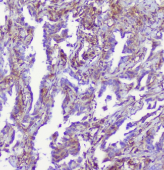 RP2 Antibody - IHC staining of FFPE human lung cancer with RP2 antibody at 1ug/ml. HIER: boil tissue sections in pH6, 10mM citrate buffer, for 10-20 min followed by cooling at RT for 20 min.