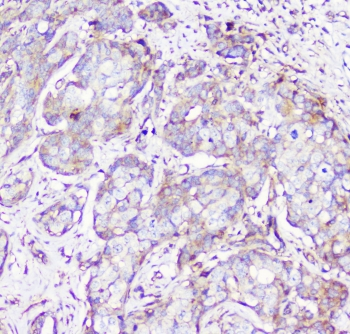 RP2 Antibody - IHC staining of FFPE human breast cancer with RP2 antibody at 1ug/ml. HIER: boil tissue sections in pH6, 10mM citrate buffer, for 10-20 min followed by cooling at RT for 20 min.