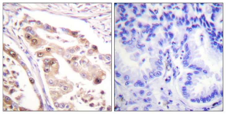 RPA2 / RFA2 / RPA34 Antibody - Immunohistochemistry analysis of paraffin-embedded human lung carcinoma tissue, using RFA2 Antibody. The picture on the right is blocked with the synthesized peptide.