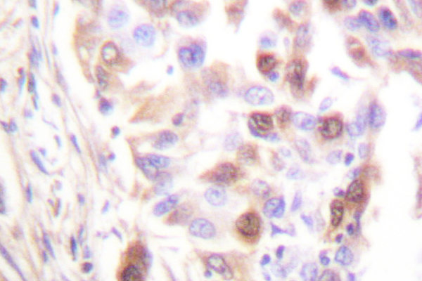 RPA2 / RFA2 / RPA34 Antibody - IHC of RFA2 (A17) pAb in paraffin-embedded human lung carcinoma tissue.