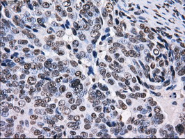 RPA2 / RFA2 / RPA34 Antibody - IHC of paraffin-embedded Adenocarcinoma of ovary tissue using anti-RPA2 mouse monoclonal antibody. (Dilution 1:50).