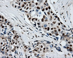 RPA2 / RFA2 / RPA34 Antibody - IHC of paraffin-embedded Adenocarcinoma of breast tissue using anti-RPA2 mouse monoclonal antibody. (Dilution 1:50).