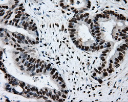 RPA2 / RFA2 / RPA34 Antibody - IHC of paraffin-embedded Adenocarcinoma of colon tissue using anti-RPA2 mouse monoclonal antibody. (Dilution 1:50).