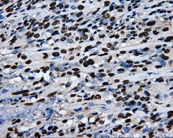 RPA2 / RFA2 / RPA34 Antibody - IHC of paraffin-embedded Carcinoma of bladder tissue using anti-RPA2 mouse monoclonal antibody. (Dilution 1:50).