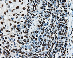RPA2 / RFA2 / RPA34 Antibody - IHC of paraffin-embedded Adenocarcinoma of ovary tissue using anti-RPA2 mouse monoclonal antibody. (Dilution 1:50).