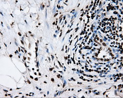 RPA2 / RFA2 / RPA34 Antibody - IHC of paraffin-embedded Carcinoma of pancreas tissue using anti-RPA2 mouse monoclonal antibody. (Dilution 1:50).