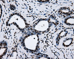 RPA2 / RFA2 / RPA34 Antibody - IHC of paraffin-embedded Carcinoma of prostate tissue using anti-RPA2 mouse monoclonal antibody. (Dilution 1:50).