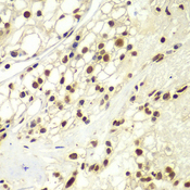 RPA2 / RFA2 / RPA34 Antibody - Immunohistochemistry of paraffin-embedded human kidney cancer tissue.