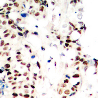 RPA2 / RFA2 / RPA34 Antibody - Immunohistochemical analysis of RPA2 (pT21) staining in human breast cancer formalin fixed paraffin embedded tissue section. The section was pre-treated using heat mediated antigen retrieval with sodium citrate buffer (pH 6.0). The section was then incubated with the antibody at room temperature and detected using an HRP conjugated compact polymer system. DAB was used as the chromogen. The section was then counterstained with hematoxylin and mounted with DPX.