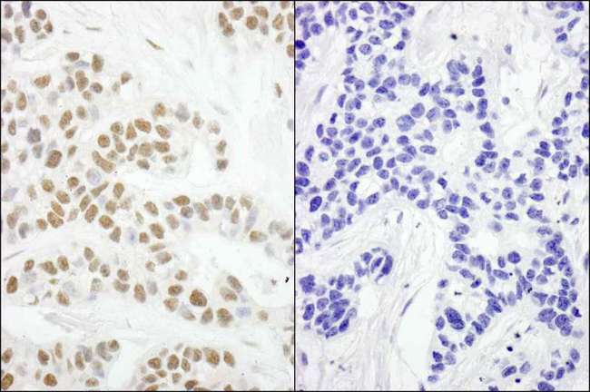 RPA2 / RFA2 / RPA34 Antibody - Detection of Human Phospho-RPA32 (S4/S8) by Immunohistochemistry. Samples: FFPE serial sections of human breast carcinoma. Mock phosphatase treated section (left) or calf intestinal phosphatase-treated section (right) immunostained for Phospho-RPA32 (S4/S8). Antibody: Affinity purified rabbit anti-Phospho-RPA32 (S4/S8) used at a dilution of 1:250.