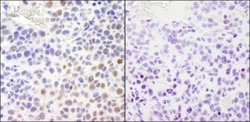 RPA2 / RFA2 / RPA34 Antibody - Detection of Mouse Phospho-RPA32 (S4/S8) by Immunohistochemistry. Samples: FFPE serial sections of mouse colon carcinoma. Mock phosphatase treated section (left) or calf intestinal phosphatase-treated section (right) immunostained for Phospho-RPA32 (S4/S8). Antibody: Affinity purified rabbit anti-Phospho-RPA32 (S4/S8) used at a dilution of 1:250.