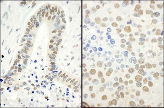 RPA2 / RFA2 / RPA34 Antibody - Detection of Human and Mouse RPA32 (S4/S8) by Immunohistochemistry. Sample: FFPE sections of human ovarian carcinoma (left) and mouse renal cell carcinoma (right). Antibody: Affinity purified rabbit anti-RPA32 (S4/S8) used at a dilution of 1:1000 (1 Detection: DAB.