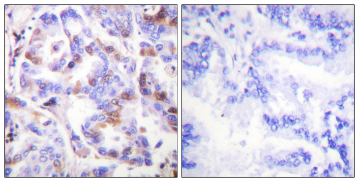 RPA2 / RFA2 / RPA34 Antibody - Immunohistochemistry analysis of paraffin-embedded human lung carcinoma, using RFA2 (Phospho-Thr21) Antibody. The picture on the right is blocked with the phospho peptide.