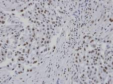 RPA3 Antibody - IHC of paraffin-embedded lung CA patient tumor using RPA3 subunit antibody at 1:100 dilution.