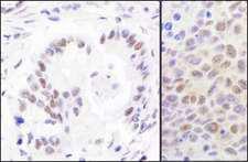 RPA70 / RPA1 Antibody - Detection of Human and Mouse RPA70 by Immunohistochemistry. Sample: FFPE sections of human stomach carcinoma (left) and mouse CT26 colon carcinoma (right). Antibody: Affinity purified rabbit anti-RPA70 used at a dilution of 1:1000 (1 ug/ml). Detection: DAB.