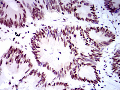 RPA70 / RPA1 Antibody - IHC of paraffin-embedded colon cancer tissues using RPA1 mouse monoclonal antibody with DAB staining.